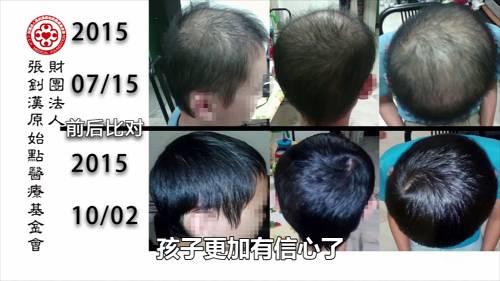 少年脱发案例（简体版）