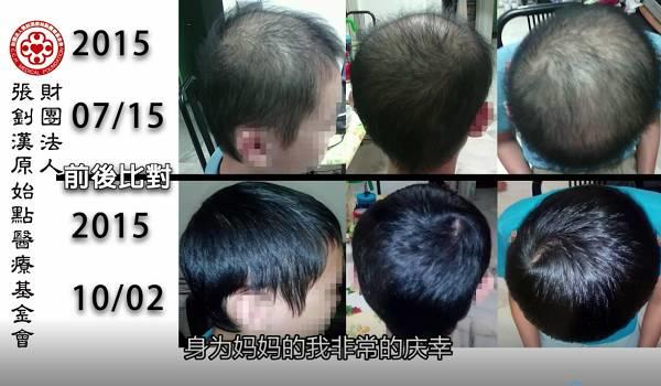 少年脱发案例（马国）（简体版）