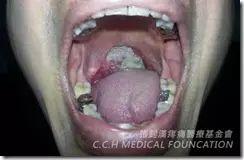 扁桃腺癌案例
