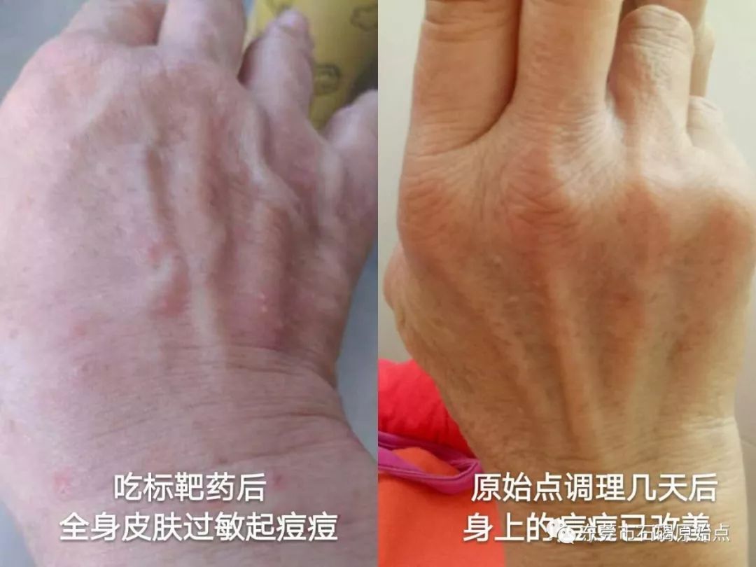 70岁钟婆婆香港人晚期肺癌用原始点调理 70岁钟婆婆香港人晚期肺癌用原始点调理