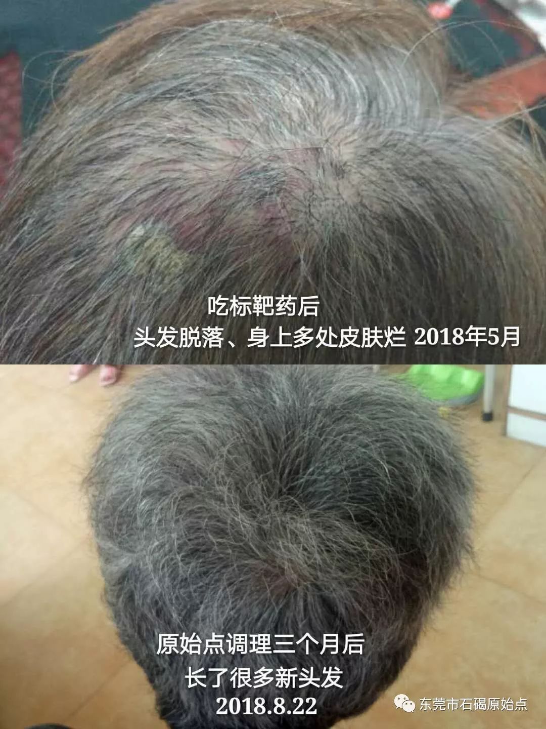 70岁钟婆婆香港人晚期肺癌用原始点调理 70岁钟婆婆香港人晚期肺癌用原始点调理