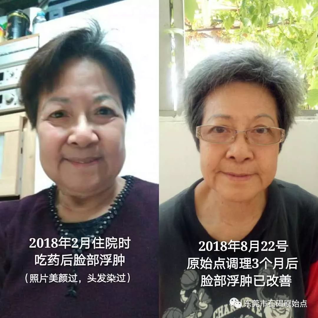 70岁钟婆婆香港人晚期肺癌用原始点调理 70岁钟婆婆香港人晚期肺癌用原始点调理