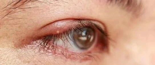 姜粉敷眼疾-七不姜 生姜養生網-明德CSA生態姜園&明安農業