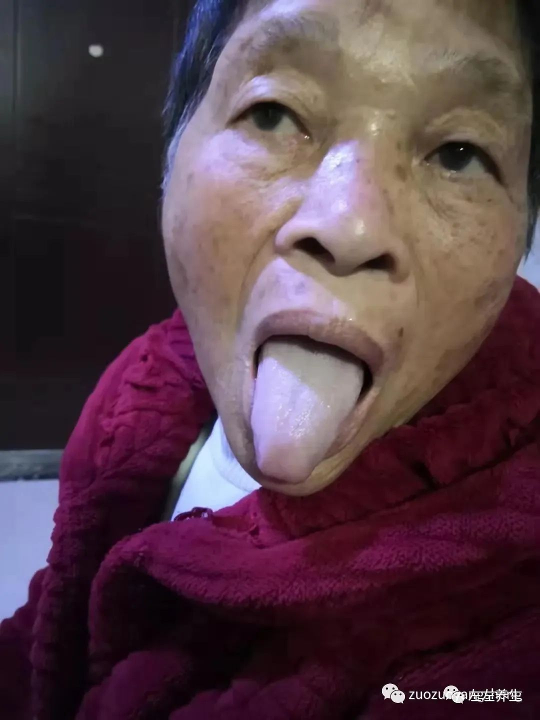 案例分享:70岁老人腹痛(医院初诊可能升结肠癌)飞蛾症、腿抽筋、失眠调理案例 案例分享:70岁老人腹痛(医院初诊可能升结肠癌)飞蛾症、腿抽筋、失眠调理案例